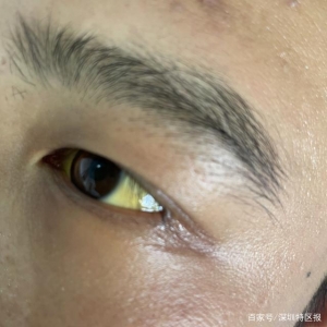 饮酒要适量！27岁深圳男子春节喝酒喝出肝衰竭！