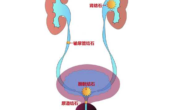 你还不爱喝水吗？这种病疼起来像刀割，越来越多年轻人中招 ... ... ...