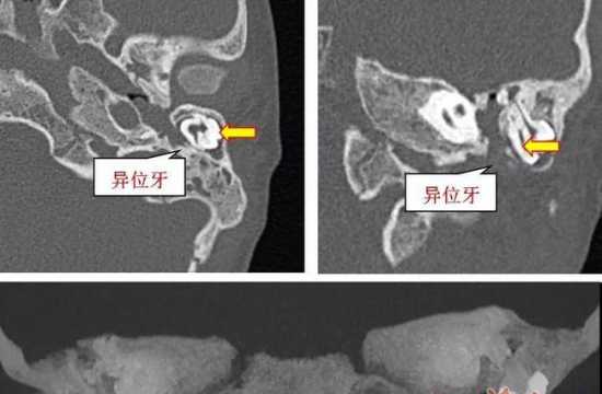 5岁男童耳朵里长了3颗牙齿：胎儿期发育紊乱所致