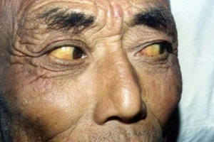 肝硬化的人或因面条吃多了？专家：想养肝的人，2种食物尽量少吃 ... ... ...