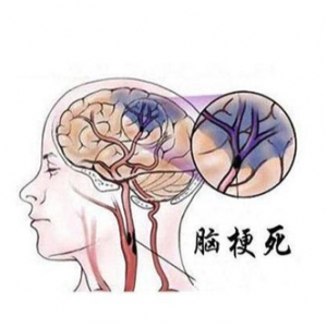 64岁老人服用他汀+阿司匹林，二次脑梗，医生：只因药没吃对 ...