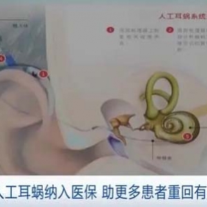 减轻约七成费用负担！人工耳蜗纳入上海医保，助患者重回有声世界