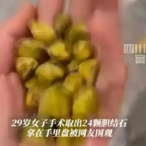 女生取24颗胆结石 留下21颗没事手里盘着玩