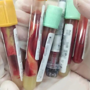 连着聚餐吃喝，杭州男子腹痛、呕吐，差点没命！每当岁末年初，这样的患者就会增多