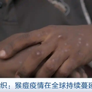 世卫组织：猴痘病毒Ib分支引起的疫情在全球持续蔓延